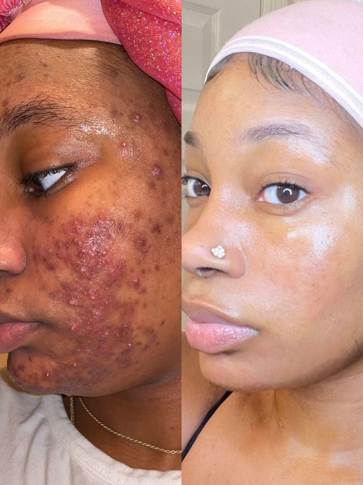 Intensive acne cream