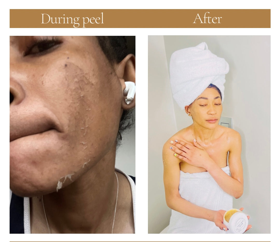 Face chemical peel