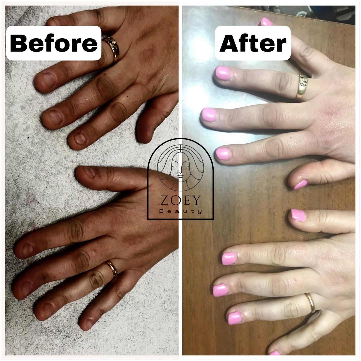 Knuckle kit for dark knuckles