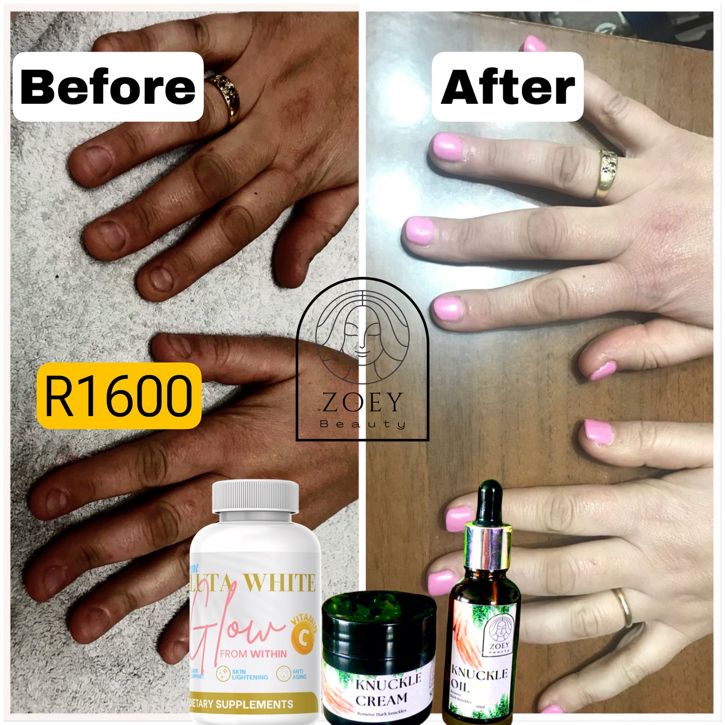Knuckle kit + Gluta White