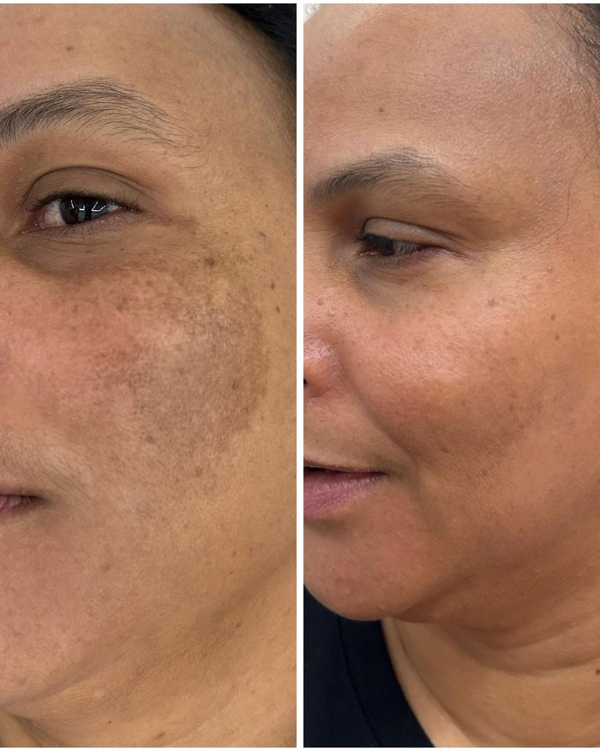 Blemish face cream