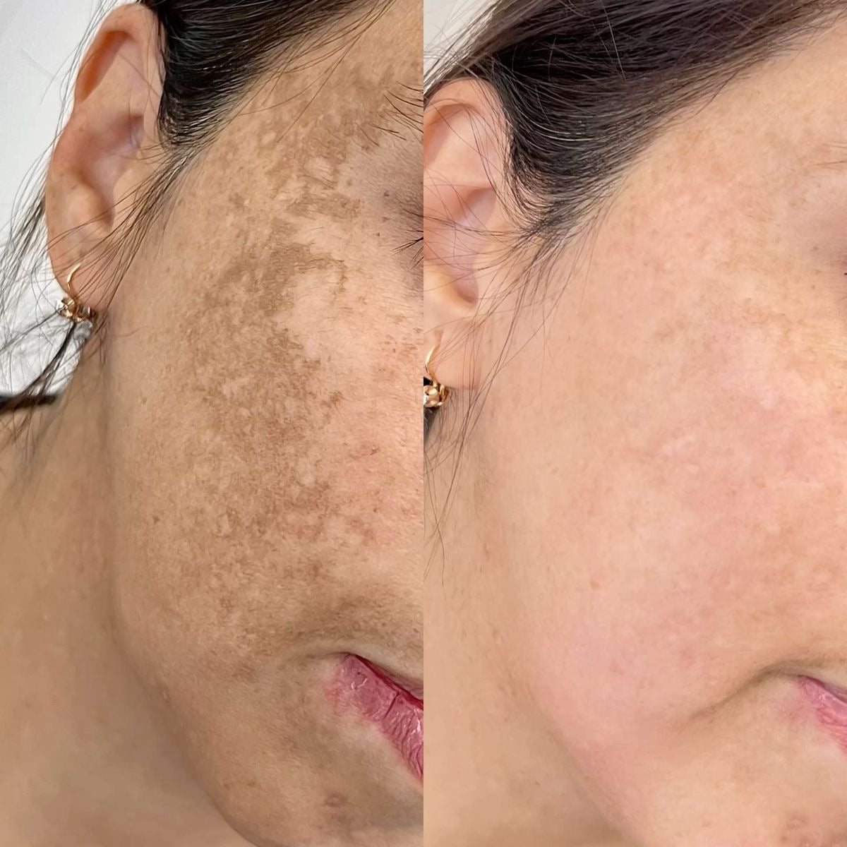 Blemish face cream