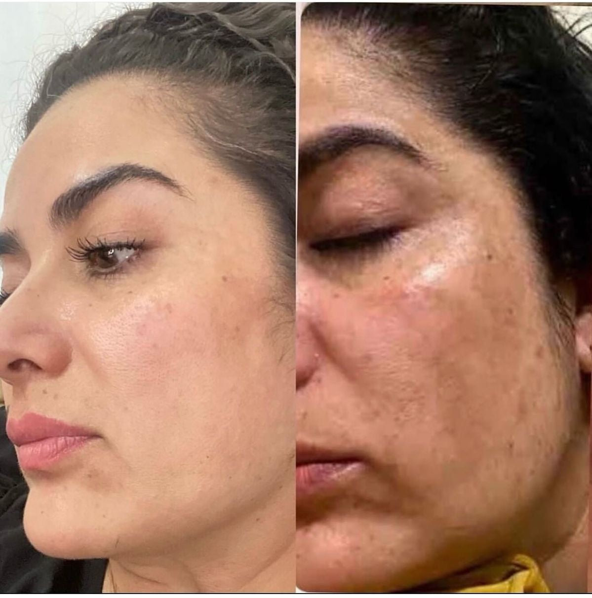 Blemish face cream