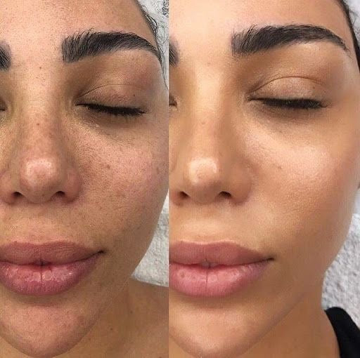 Dark spots
