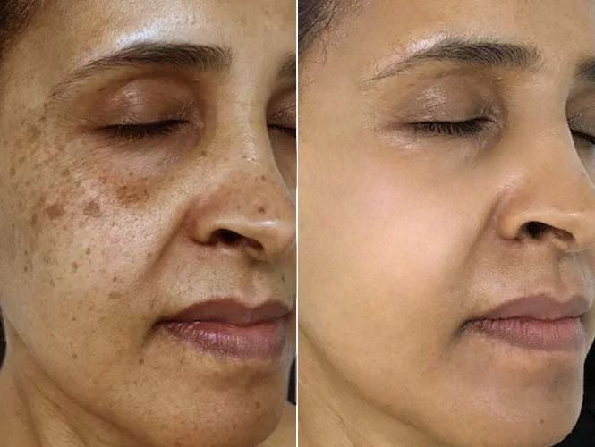 Dark spots