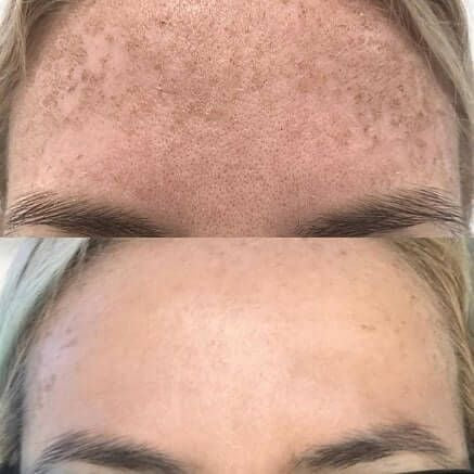 Dark spots