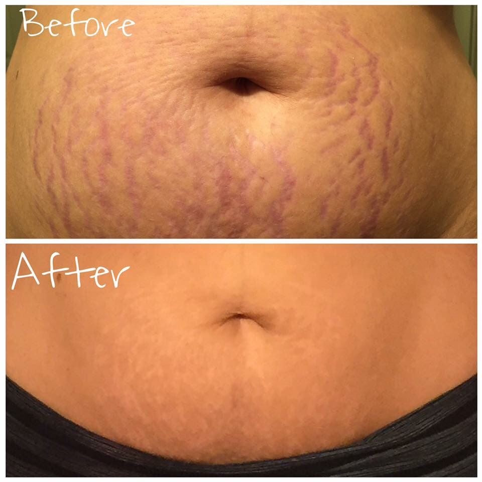 Stretch marks butter + FREE tissue oil