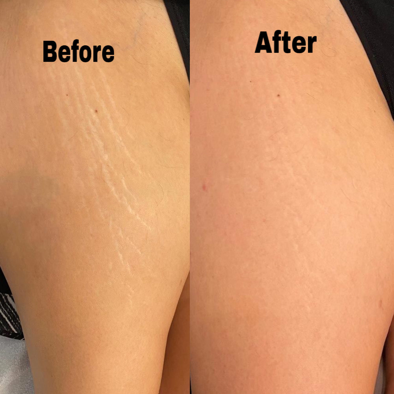 Stretch marks butter + FREE tissue oil