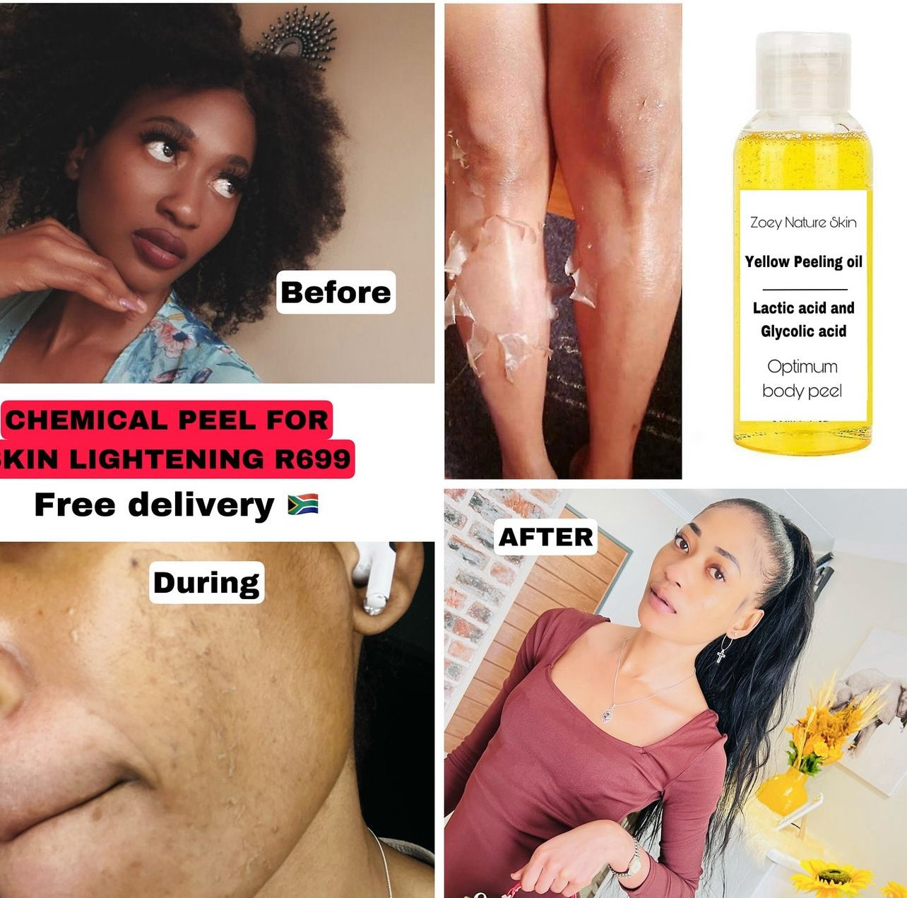 Chemical peel