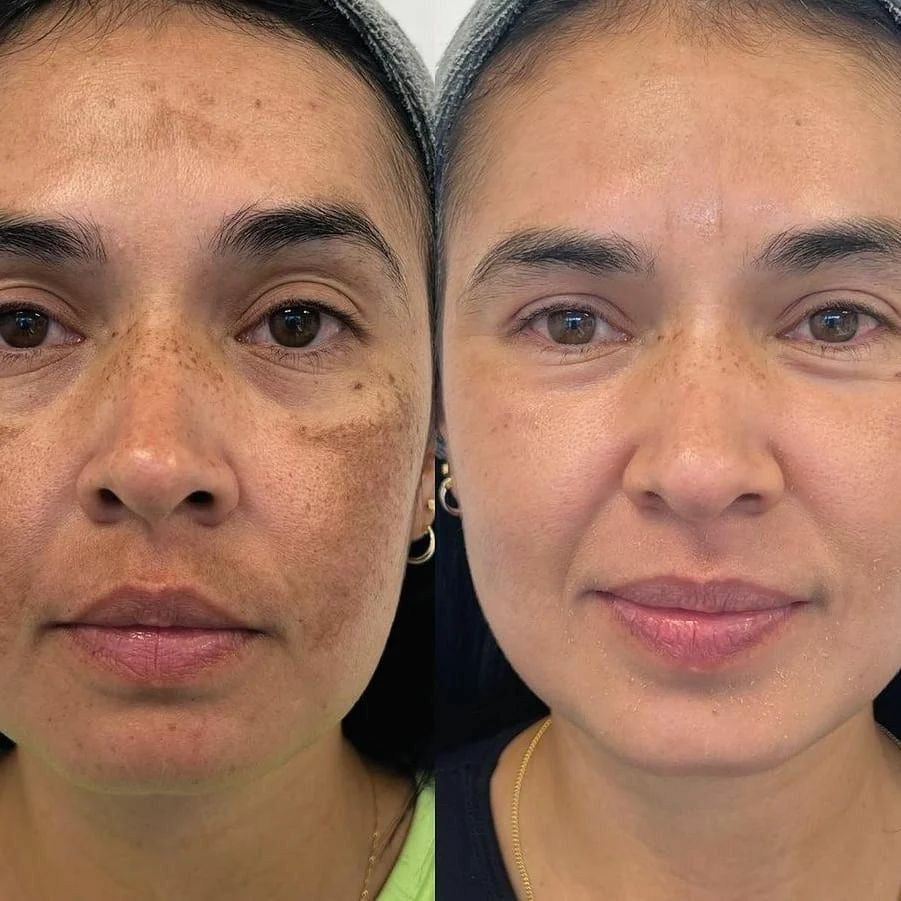 Blemish face cream
